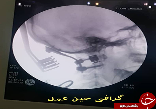 گرافی حین عمل