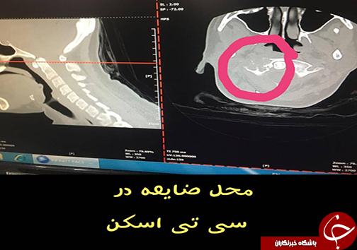 محل ضایعه در سی تی اسکن