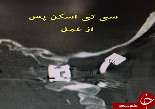 سی تی اسکن پس از عمل