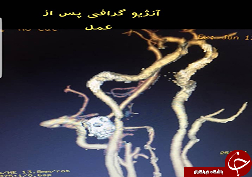 آنژیوگرافی پس از عمل جراحی