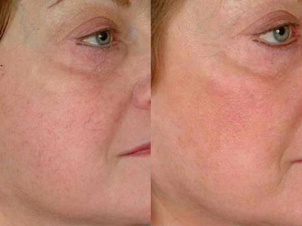 دلایل ایجاد رگ‌های عنکبوتی بر روی صورت چیست؟ + درمان