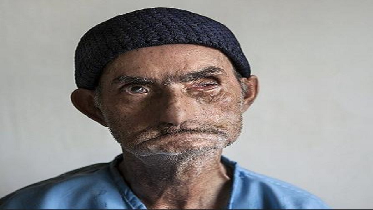 تشرف ۱۲۰ بیمار جذامی به حرم رضوی