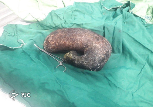 خارج کردن توده عجیب از شکم یک دختر در ساری+ تصویر