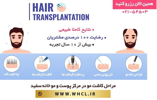 درمان ریزش مو ارثی چگونه است ؟