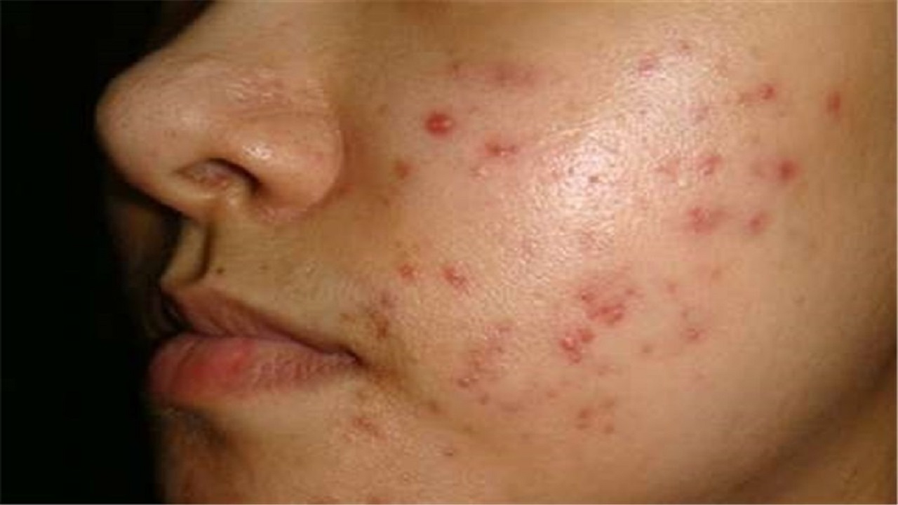 چگونه از لک‌های آکنه پیشگیری کنیم؟