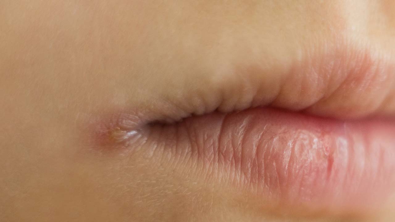 شقاق گوشه‌ی لب چیست؟