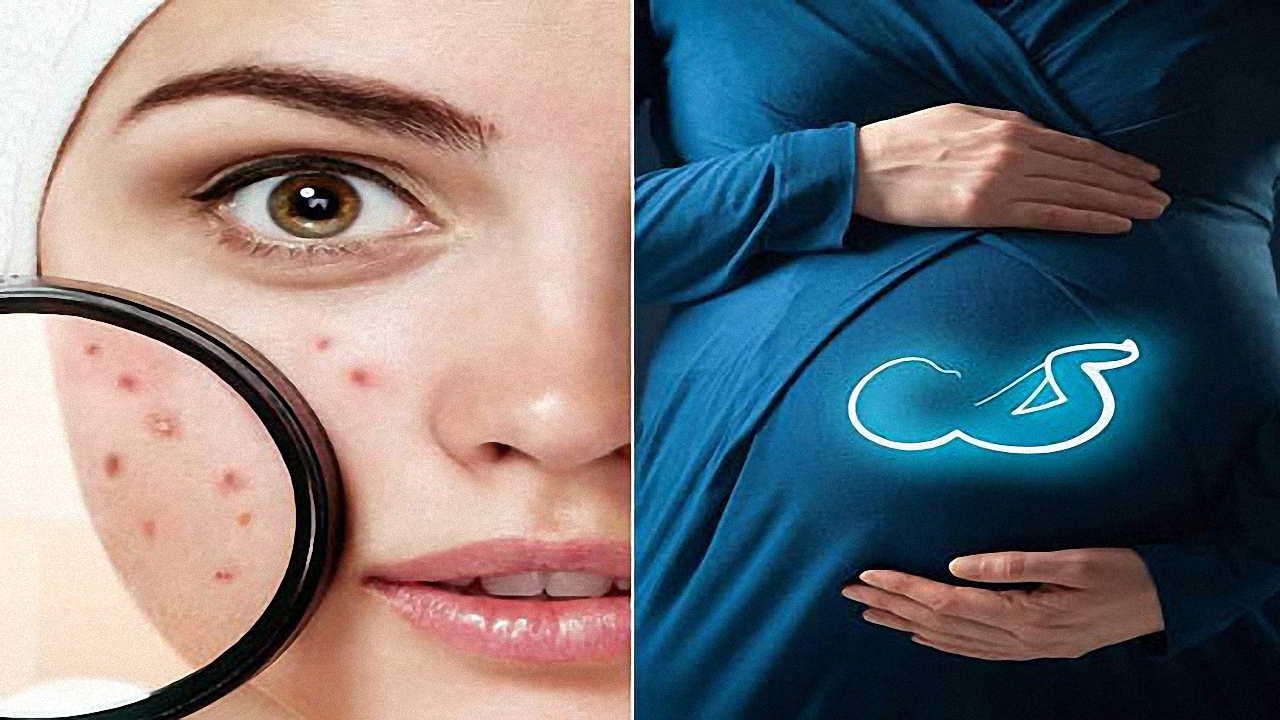 راهکارهایی برای درمان جوش‌های دوران بارداری
