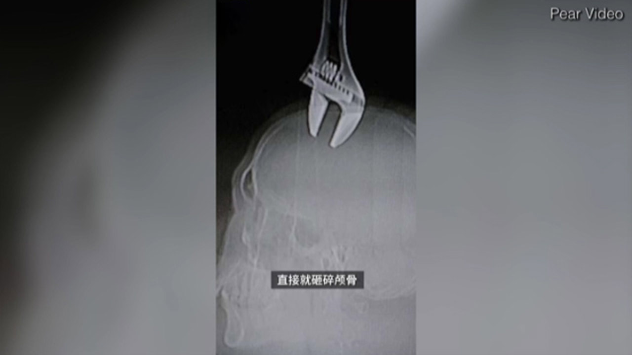 زنده ماندن معجزه آسای یک مرد پس از فرو رفتن آچار فرانسه به سرش + فیلم