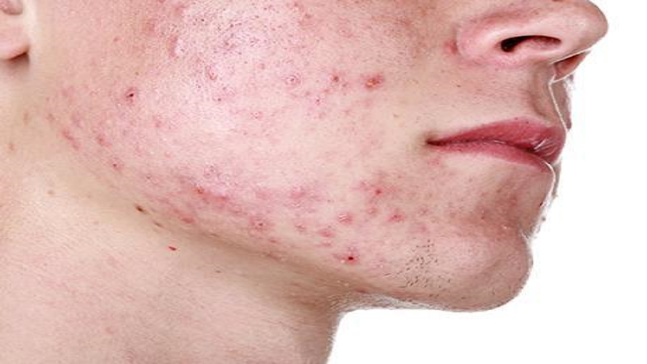 اختلالات هورمونی در بدن و ۵ ماده غذایی ممنوعه