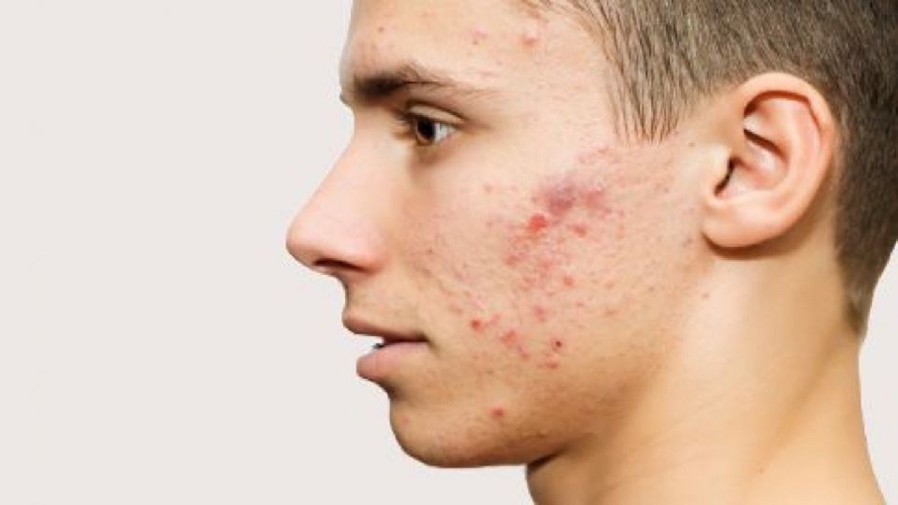 چه بخوریم تا جوش نزنیم؟