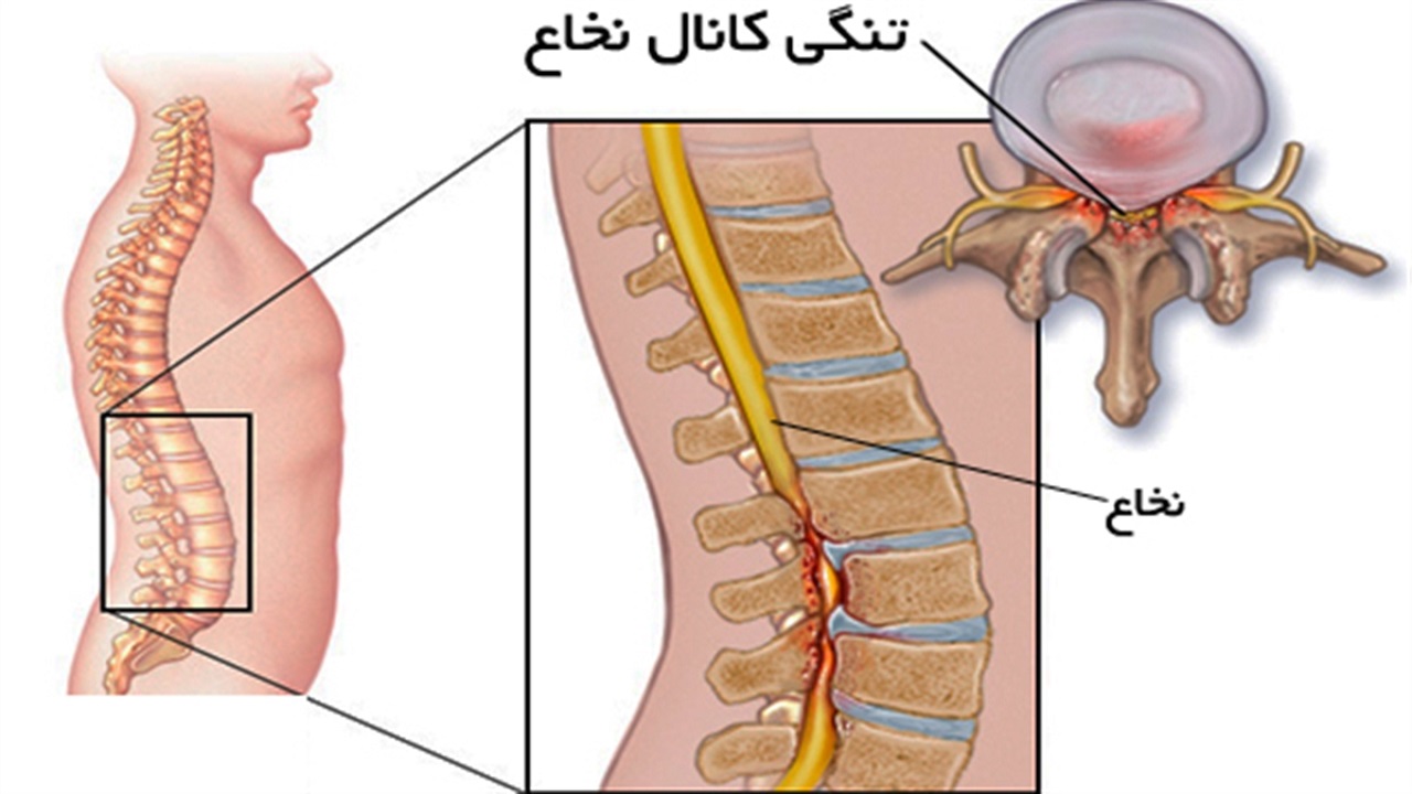 با تنگی کانال نخاعی چه باید کرد؟ / چه ورزش‌هایی مناسب این عارضه هستند؟