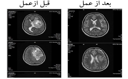 عمل میکروسکوپی موفقیت&zwnj;آمیز دختر ۱۵ ساله قمی