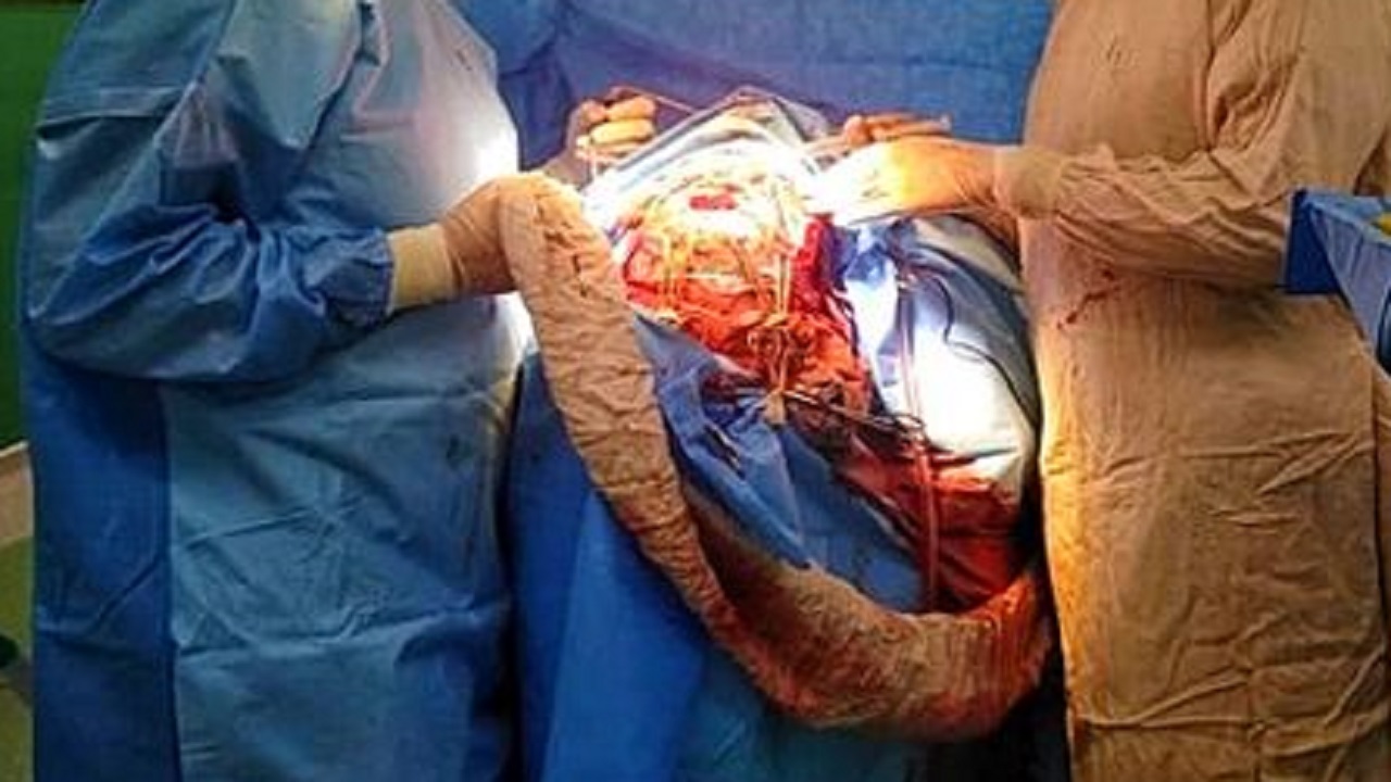 عمل میکروسکوپی موفقیت‌آمیز دختر ۱۵ ساله قمی