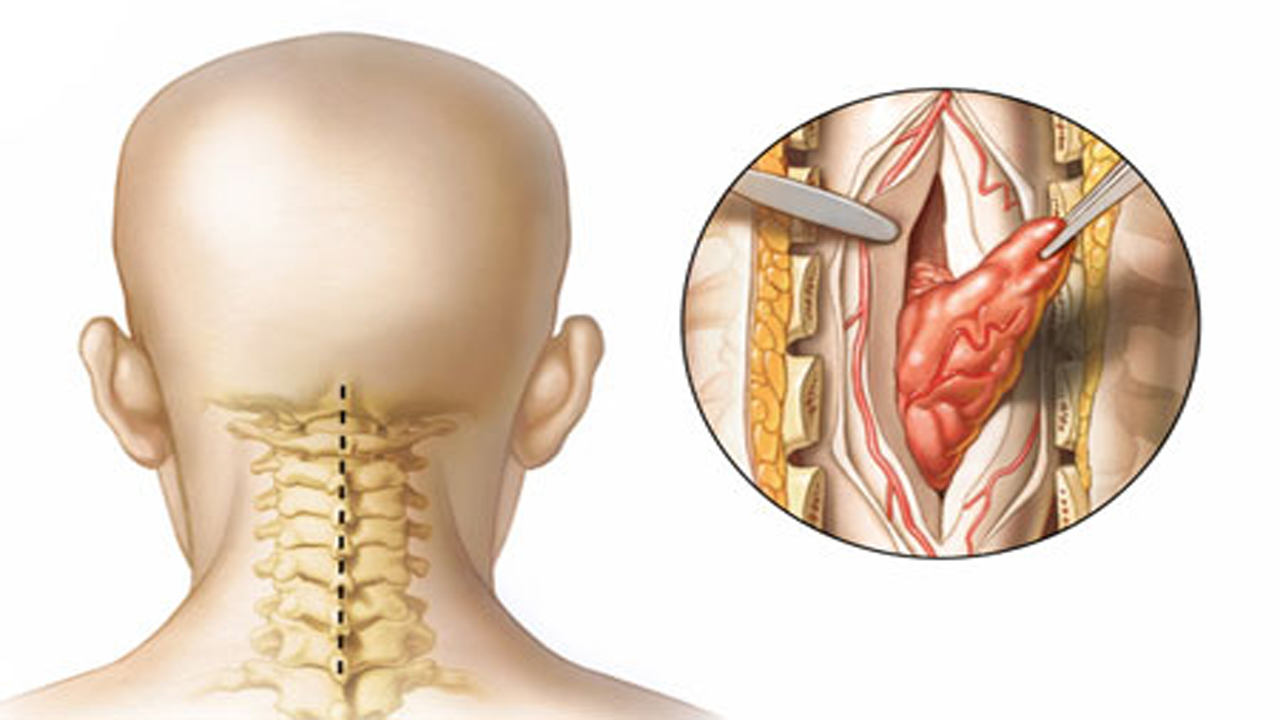 جراحی تومور نخاع گردن با شرایط خاص در خراسان شمالی
