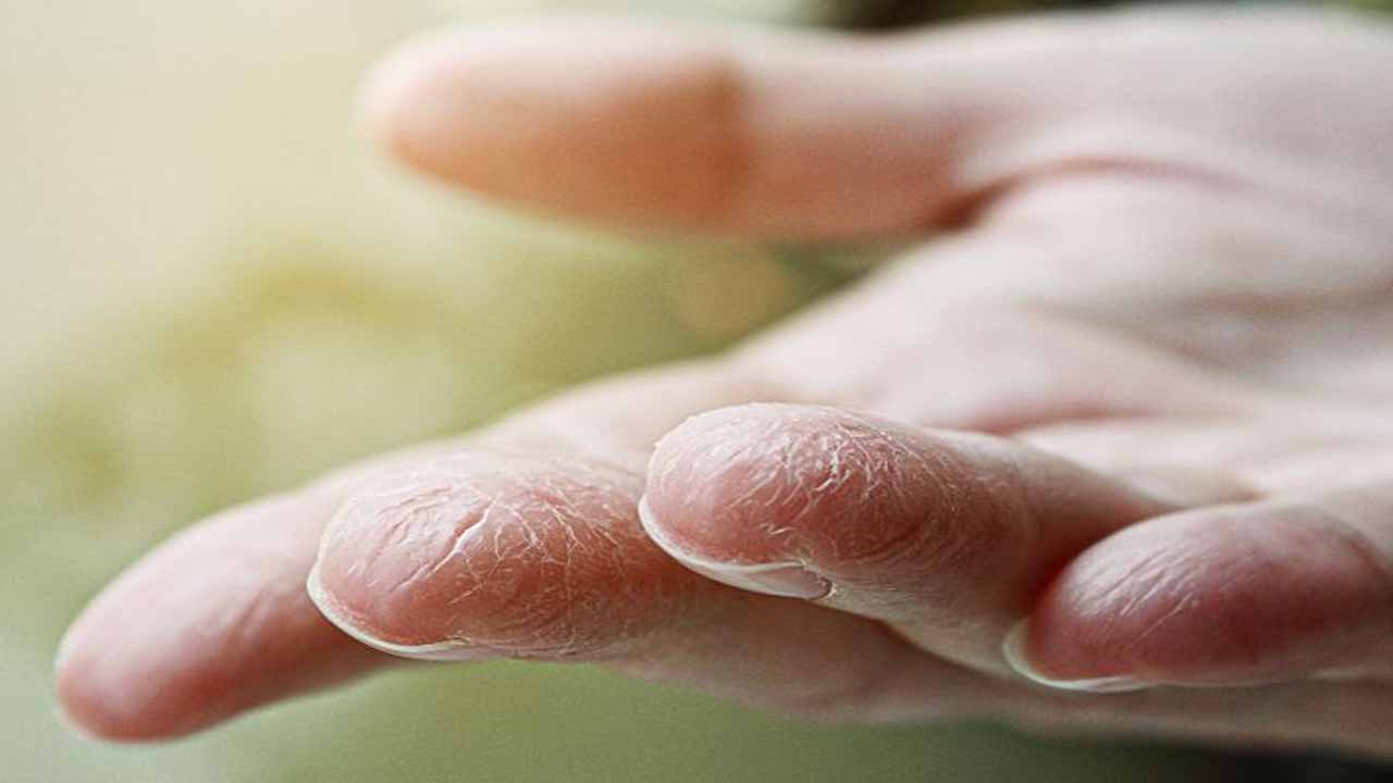 خشکی دست‌ها را با ۵ راهکار ساده از بین ببرید!