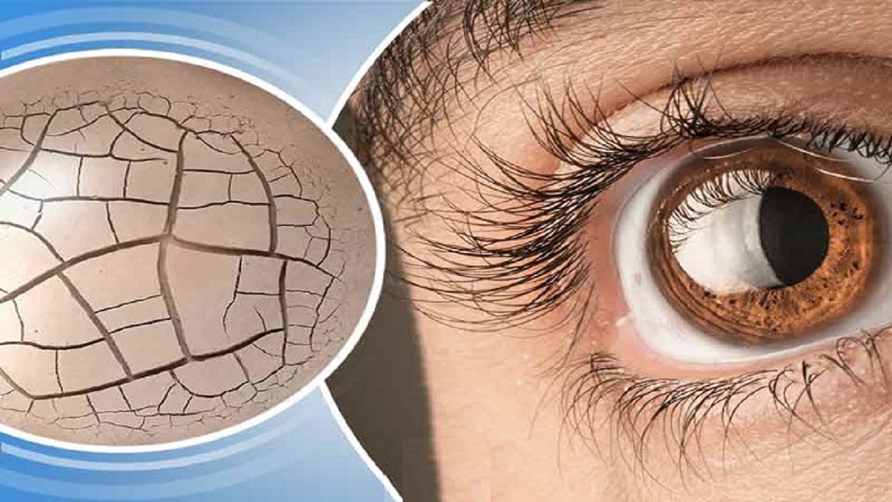 چند روش خانگی برای رفع خشکی چشم
