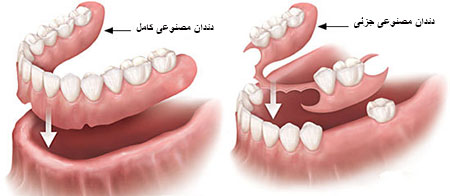 هر آنچه در مورد دندان مصنوعی باید بدانید