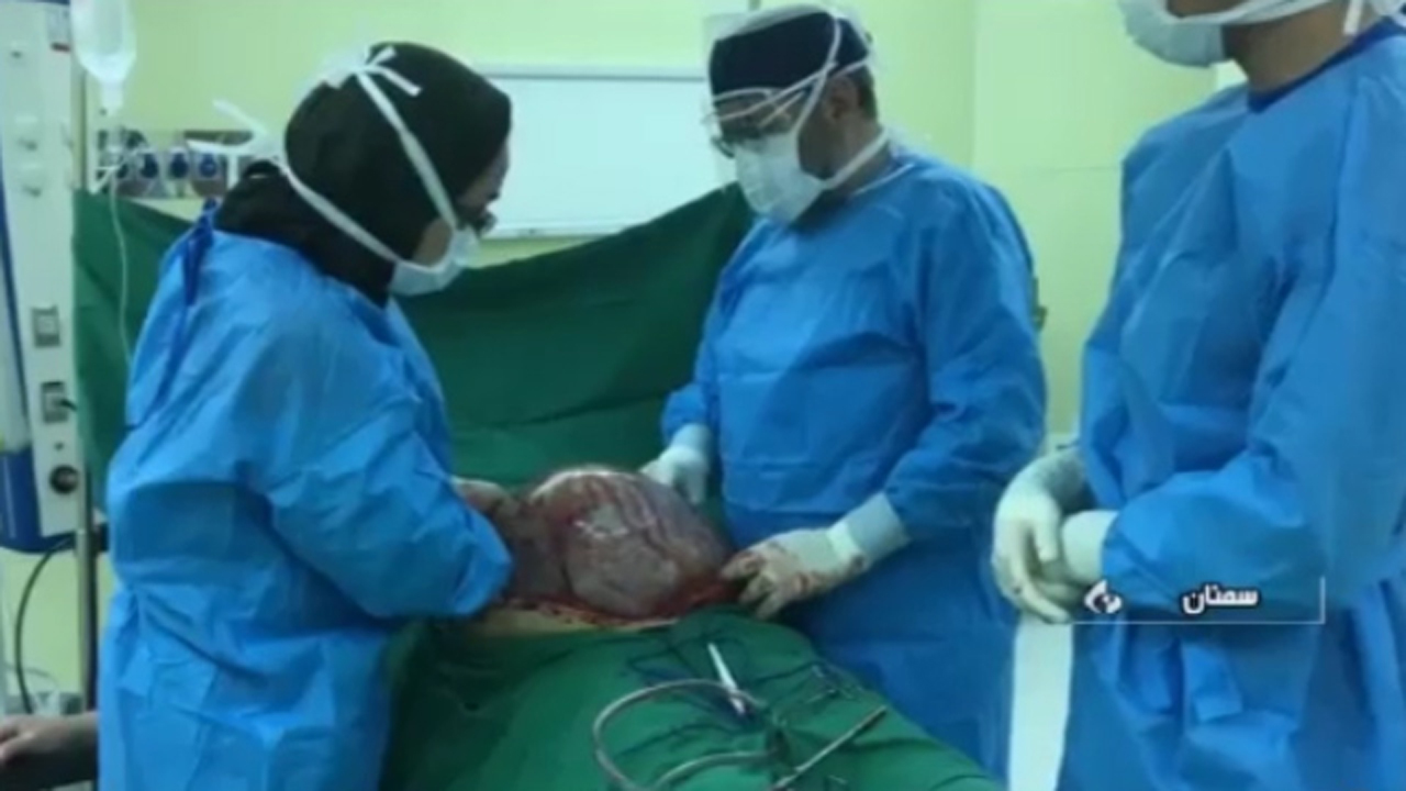 خارج کردن توده ۱۶ کیلوگرمی از شکم یک زن ایرانی! + فیلم