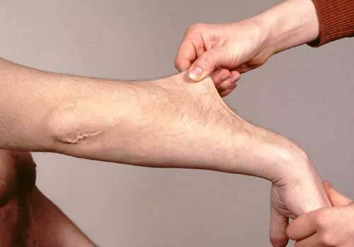 عکس ها کامل شود/ مهم&zwnj;ترین سندرم&zwnj;های جهان که باید با آن&zwnj;ها آشنا شوید