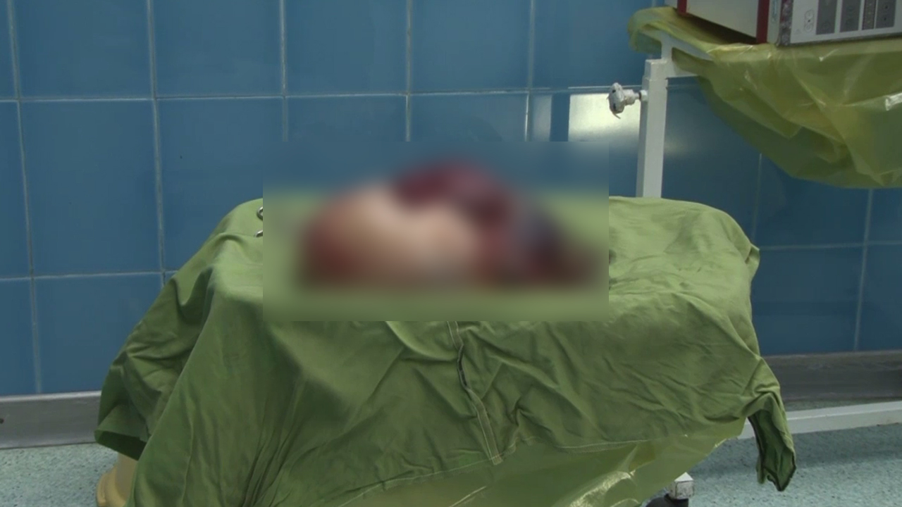 خارج کردن توده ۱۲ و نیم کیلویی از شکم زن بهشهری