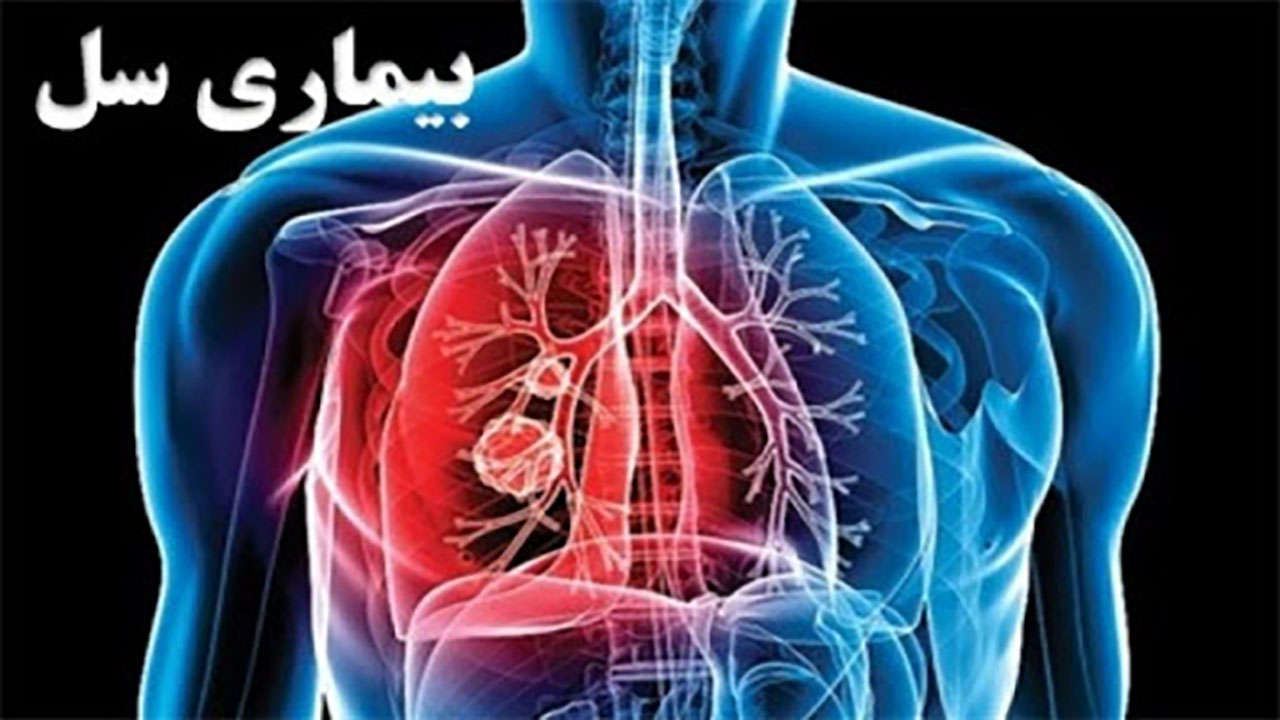 انتقال بیماری سل از طریق تنفس از فرد مبتلا به فرد سالم
