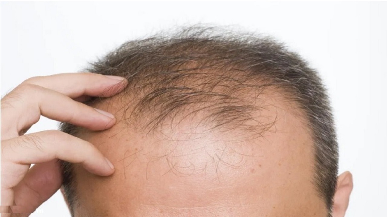دلایل رایج ریزش مو در تابستان و پاییز چیست؟