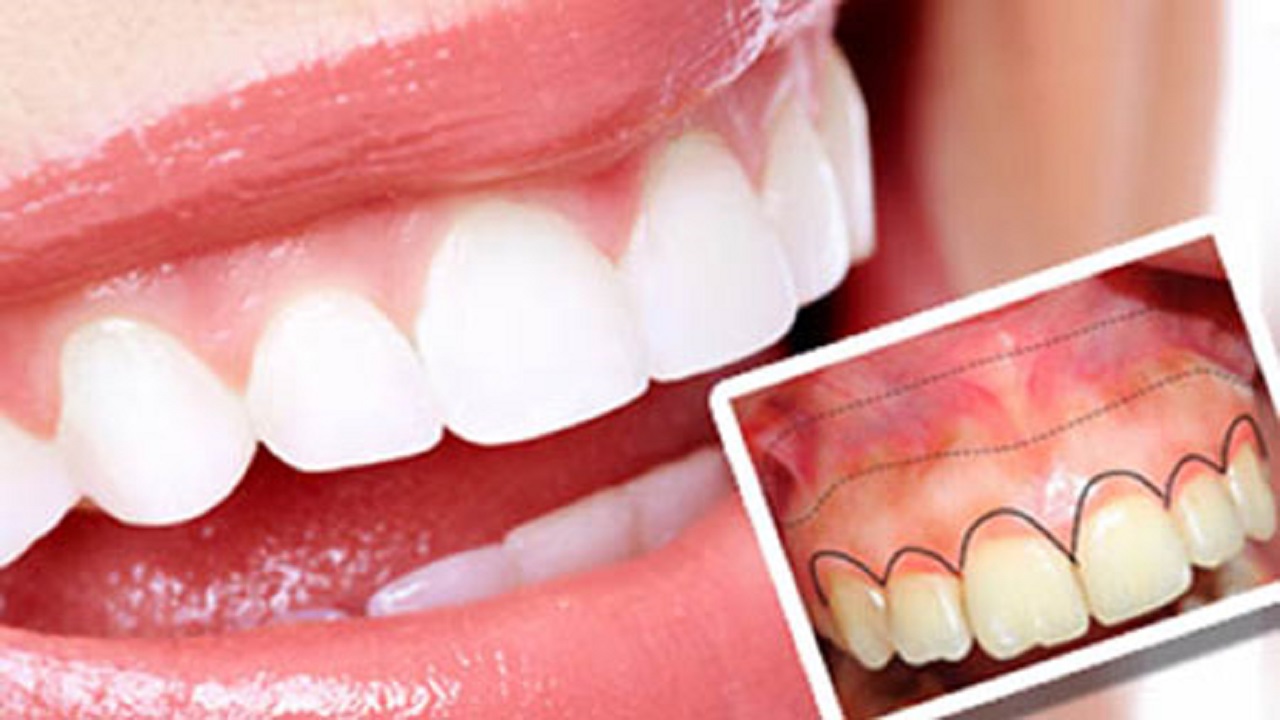 راه‌های جلوگیری از تحلیل رفتن لثه