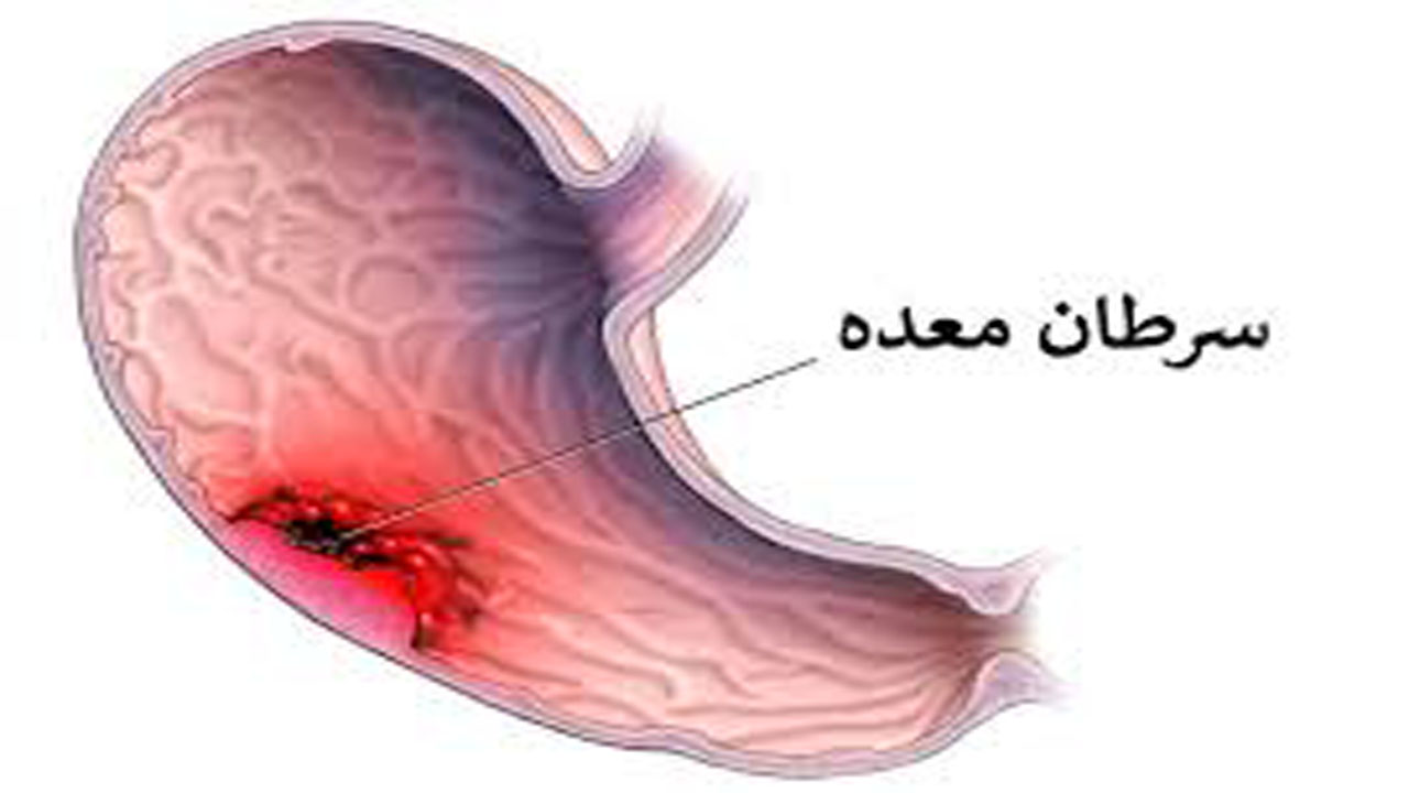 سرطان معده، نخستین سرطان شایع در آقایان