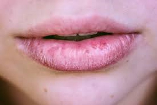 ترک گوشه&zwnj;های لب نشانه یک مشکل عفونیاین نوع عفونت می&zwnj;تواند به زبان، گونه ها، سقف دهان، لثه ها، لوزه&zwnj;ها و یا پشت گلو گسترش یابد. مطالعات نشان می&zwnj;دهد که برفک دهانی در افراد مسن به دلیل کاهش ایمنی بیشتر دیده می&zwnj;شود.ترک خوردن گوشه&zwnj;های دهان یکی از مهمترین نشانه&zwnj;های عفونت قارچی است و علائم دیگری از برفک دهان نیز وجود دارد که باید به آن&zwnj;ها توجه کنید.وقتی به داخل دهان خود در آینه نگاه می&zwnj;کنید، ممکن است متوجه ضایعات سفید و شفاف و خامه&zwnj;ای شوید و این ضایعات برجسته می&zwnj;توانند کمی شبیه ظاهر پنیر کاتاژ باشند و در صورت مالش یا خراش ممکن است خونریزی کنند.ناحیه دهان نیز ممکن است قرمز و زخم بوده و این درد به حدی شدید باشد که هنگام خوردن و یا قورت دادن غذا مشکل ایجاد کند.برخی افراد در دهان خود احساس پنبه می&zwnj;کنند که این یکی دیگر از علائم عفونت است.برفک دهان را می&zwnj;توان توسط پزشک یا دندانپزشکی تشخیص داد که دهان شما را معاینه می&zwnj;کند. درمان نیز معمولاً شامل نسخه&zwnj;ای از دارو&zwnj;های ضد قارچ است، اما یک سری اقدامات احتیاطی وجود دارد که می&zwnj;توانید در وهله نخست برای جلوگیری از عفونت انجام دهید:مسواک زدن حداقل دو بار در روز و نخ دندان کشیدن روزانهمسواک را با افراد دیگر به اشتراک نگذارید و مسواک خود را به طور مرتب تعویض کنید.برای کسانی که از دندان مصنوعی استفاده می&zwnj;کنند، شب آن&zwnj;ها را برداشته و روزانه تمیز کنند.دهان خود را با آب نمک گرم غرغره کنید یا با دهان شویه دارویی بشویید.بیشتر بخوانید:انتهای پیام/