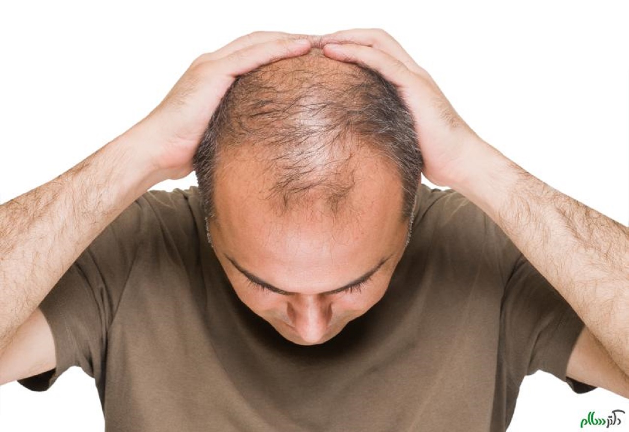 چگونه با استفاده از قهوه مانع ریزش موی خود شویم؟