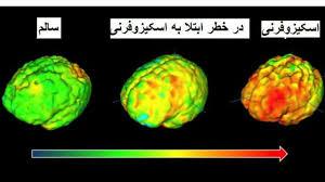 اسکیزوفرنی