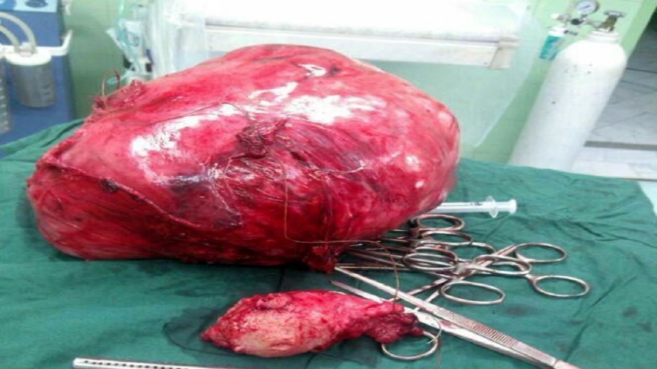 خارج کردن دو توده ۱۲ کیلویی از شکم زن میانسال نهاوندی