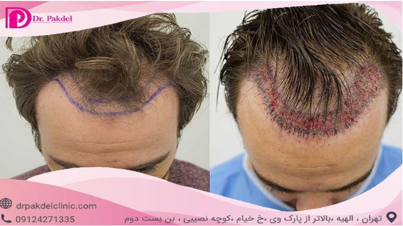 کاشت مو چگونه انجام می شود؟/ انواع روش ها و عوارض
