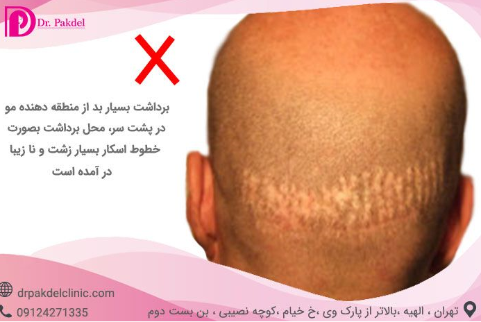 کاشت مو چگونه انجام می شود؟/ انواع روش ها و عوارض