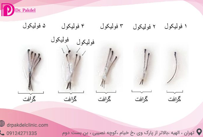 کاشت مو چگونه انجام می شود؟/ انواع روش ها و عوارض