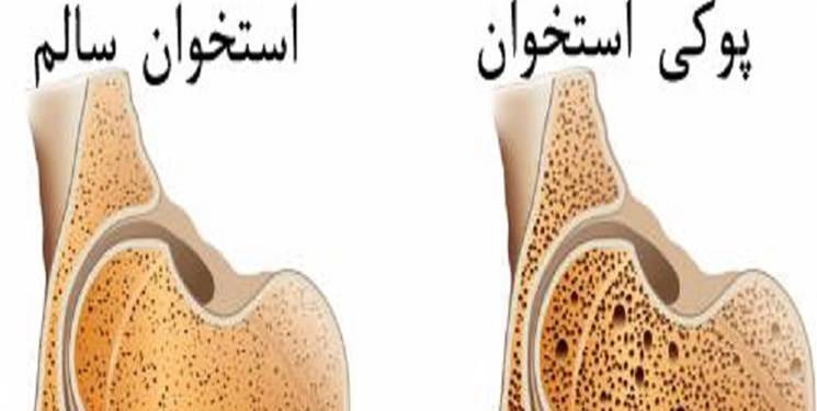 پوکی استخوان ذخیره کودکی برای سالمندی