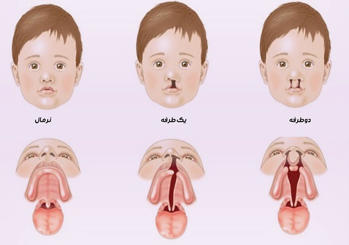 اصفهان موفق در پیشگیری از بیماری شکاف لب و کام و پیشتاز در درمان آن