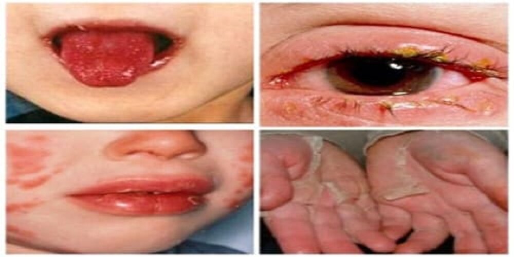 علائم عجیب پساکرونایی؛ از سندرم مخوف کاوازاکی تا لکنت زبان و حملات صرعی/ تاپ نیوز