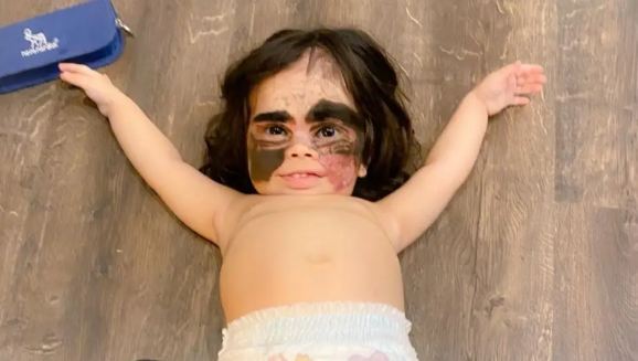 دختربچه&zwnj;ای با ماه گرفتی عجیب شبیه بتمن شد+ تصاویر