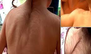 کودکانی شبیه به گرگینه در اثر مصرف اشتباه دارو
