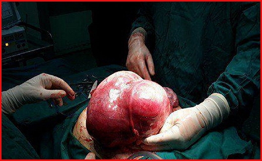 خارج کردن توده ۱۵ کیلوگرمی از شکم بیمار صحنه ای