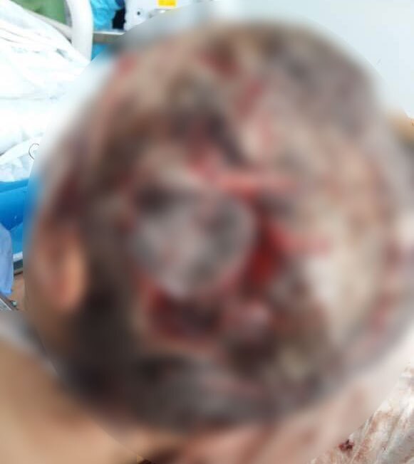 ترسناک&zwnj;ترین سرنوشت یک زن ایرانی / اشرف سادات حسینی تکه تکه شد اما زنده ماند +  (تصاویر 16+)