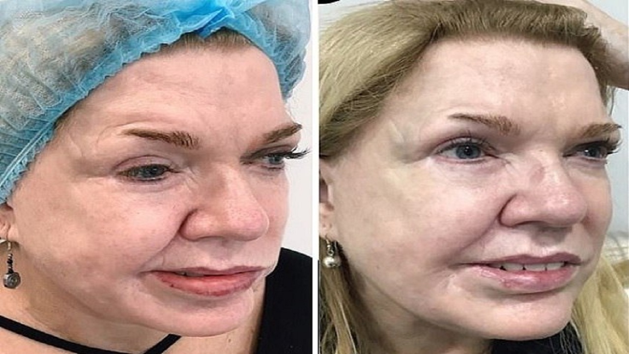 تزریق بوتاکس نقص ۱۹ ساله صورت یک زن را اصلاح کرد + تصاویر
