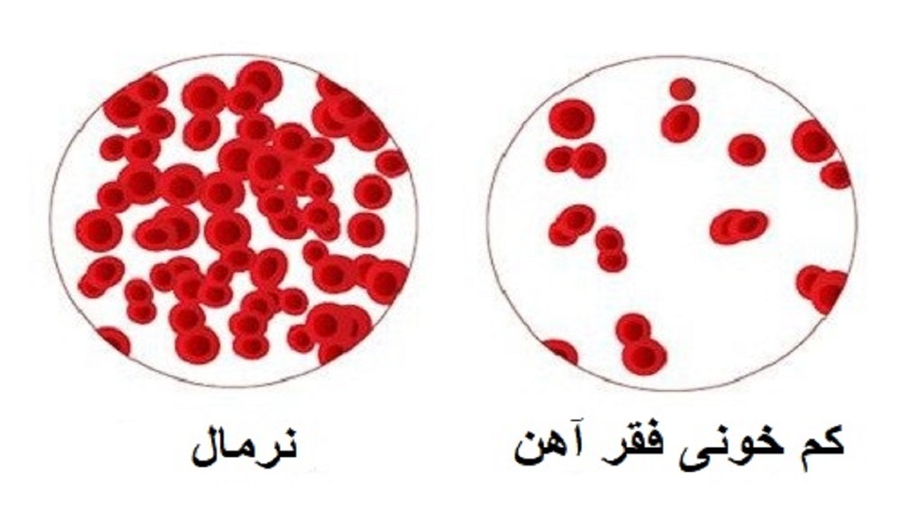 شایع ترین علائم کم خونی را بشناسید