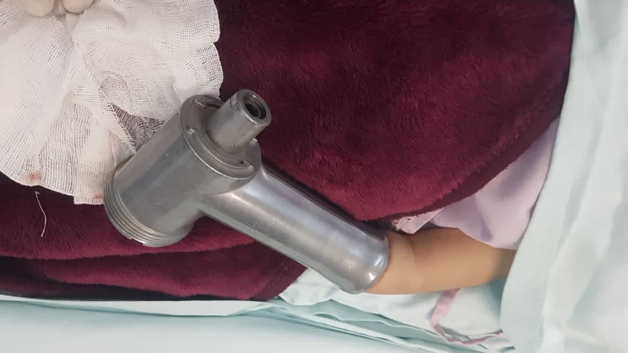 جزئیات گیر کردن دست کودک سه ساله ای در داخل چرخ گوشت