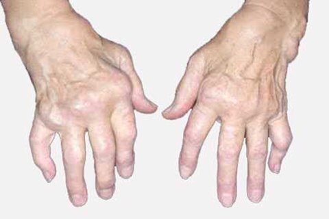 دردناکترین سندرم مرتبط با بیماری روماتیسم