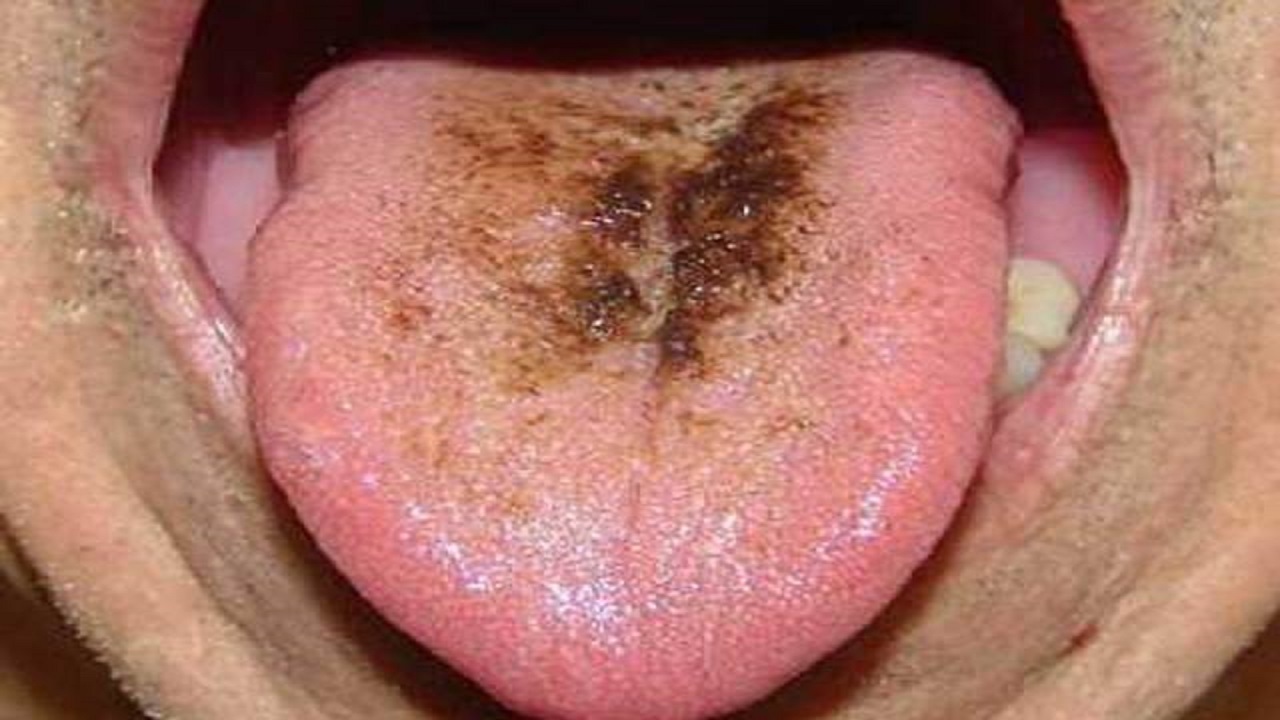 ۷ دلیل احتمالی ایجاد لکه‌های تیره بر روی زبان