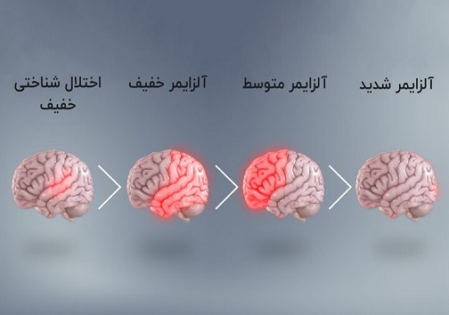 چه کنیم و چه بخوریم تا آلزایمر نگیریم؟