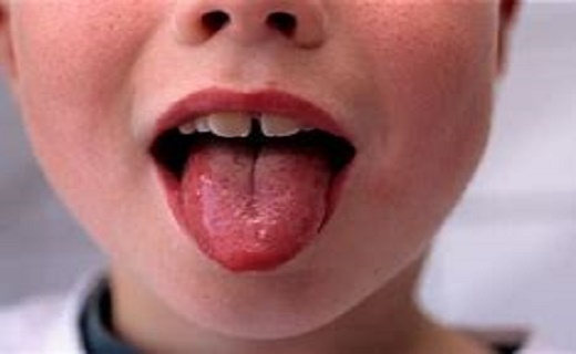 مخملک چیست و علایم آن کدامند؟