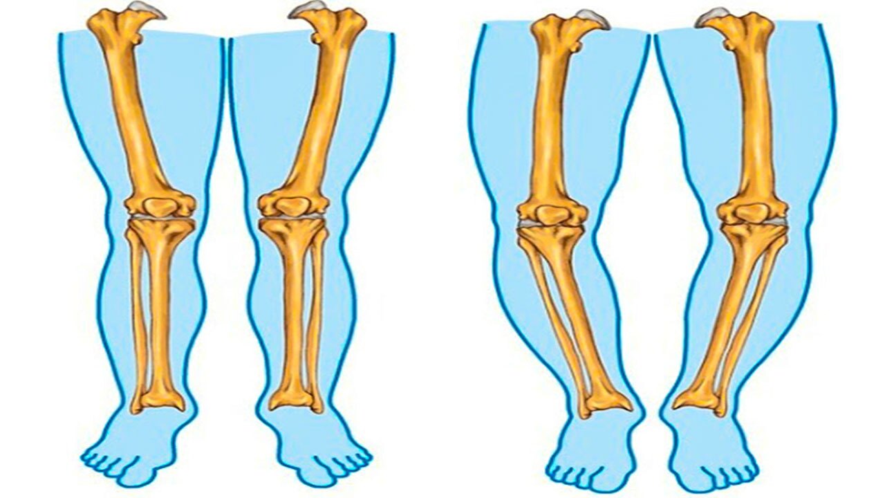 عوامل موثر در شکل گیری پای پرانتزی + فیلم